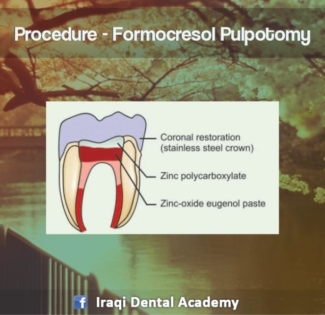Pulpotomy Procedure for Pediatrics in Detail