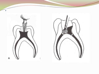 A.DEVITALIZATION (SINGLE SITTING)FORMOCRESOL PULPOTOMY TECHNIQUEFirst advocated by SWEET(1930)FORMOCRESOL SOLUTION:                                         *19% formaldehyde                                         *35% cresol                                         *15% glycerine (veichle)Buckley’s solution: 1:5 conc. Of formocresol solution.