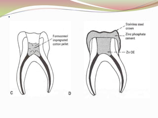 ..To prepare a 1:5 conc. Of this formula-First thoroughly mix  3 part of glycerinre with 1 part of distilled water Then add 4 parts of this preparation to 1 part Buckley’s formocresol & thoroughly mix againMechanism Of Action:Formocresol prevents tissue autolysis by bonding to protein. This is reversible process and is accomplished without changing the basic overall structure of the protein molecules