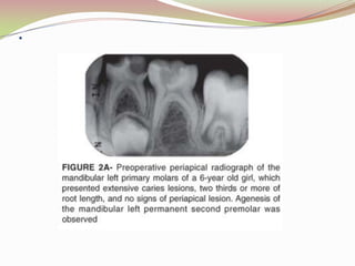 Vital tooth with healthy periodontium