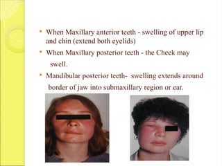  When Maxillary anterior teeth - swelling of upper lip
and chin (extend both eyelids)
 When Maxillary posterior teeth - the Cheek may
swell.
 Mandibular posterior teeth- swelling extends around
border of jaw into submaxillary region or ear.
 