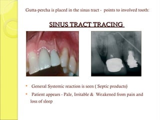 Gutta-percha is placed in the sinus tract - points to involved tooth:
SINUS TRACT TRACING
SINUS TRACT TRACING
 General Systemic reaction is seen ( Septic products)
 Patient appears - Pale, Irritable & Weakened from pain and
loss of sleep
 