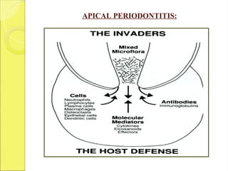 APICAL PERIODONTITIS:
 