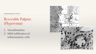 1. Vasodilatation
2. Mild inﬁltration of
inﬂammatory cells
Histopathological PIcture
Reversible Pulpitis
(Hyperemia)
 