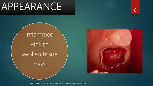 Pulp polyp ...Dr.Anubhuti | PPTX
