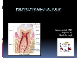 PULP POLYP & GINGIVAL POLYP
Department of OMR
Prepared by:
Akanksha singh
 