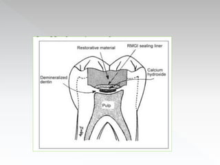 Pulp Protection Graphics Pulp protection in operative dentistry | PPTX
