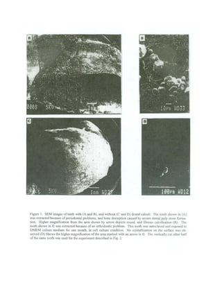 Multiple Pulp Stone Pulp stones formation pdf | PDF