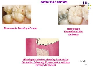 Pulp Bleeding Color Pulp Therapy by nishtha | PPT
