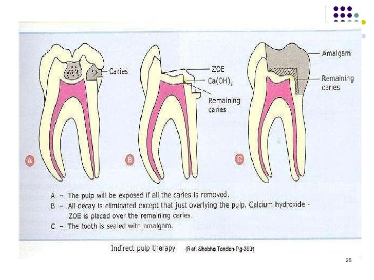 indirect pulp cap