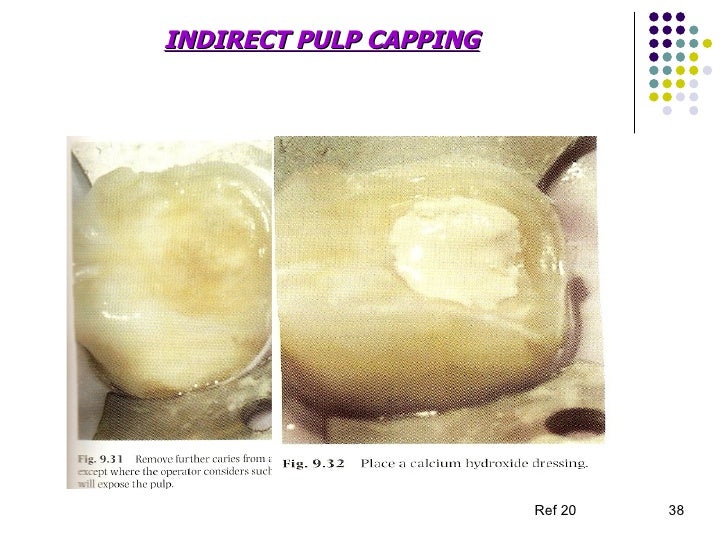 indirect pulp cap