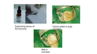 Expressing excess of
formocresol
Cotton pellet in pulp
chamber
IRM in
chamber
 