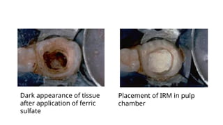 Dark appearance of tissue
after application of ferric
sulfate
Placement of IRM in pulp
chamber
 
