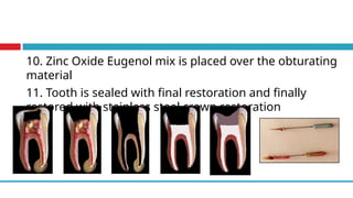 10. Zinc Oxide Eugenol mix is placed over the obturating
material
11. Tooth is sealed with final restoration and finally
restored with stainless steel crown restoration
 