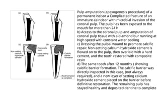 Pulp amputation (apexogenesis procedure) of a
permanent incisor a Complicated fracture of an
immature a) incisor with microbial invasion of the
coronal pulp. The pulp has been exposed to the
mouth for more than 24 h
b) Access to the coronal pulp and amputation of
coronal pulp tissue with a diamond bur running at
high speed with constant water cooling
c) Dressing the pulpal wound to promote calcific
repair. Non-setting calcium hydroxide cement is
flowed on to the pulp, then overlaid with a hard
cement, and the tooth restored with composite
resin
d) The same tooth after 12 months ) showing
calcific barrier formation. The calcific barrier was
directly inspected in this case, (not always
required), and a new layer of setting calcium
hydroxide cement placed on the barrier before
definitive restoration. The remaining pulp has
stayed healthy and deposited dentine to complete
 