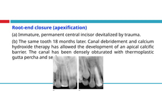 Root-end closure (apexification)
(a) Immature, permanent central incisor devitalized by trauma.
(b) The same tooth 18 months later. Canal debridement and calcium
hydroxide therapy has allowed the development of an apical calcific
barrier. The canal has been densely obturated with thermoplastic
gutta percha and sealer
 