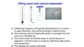 Filling canal with calcium hydroxide
paste
a) Following irrigation and gentle debridement in a crown-
to-apex direction, the working length is determined
b) Non-setting calcium hydroxide paste is syringed into the
canal via a flexible tip
c) The same tooth 18 months later. A calcific barrier is
apparent, and the tooth is ready for definitive obturation
and restoration
d) The flexible tip system (Ultracal)
 