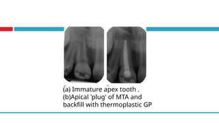 (a) Immature apex tooth .
(b)Apical 'plug' of MTA and
backfill with thermoplastic GP
 