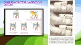 Pulp therapy in pediatric dentistry | PPTX