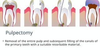 Pulpuctomy PULP therapy in primary teeth..... pptx | PPTX