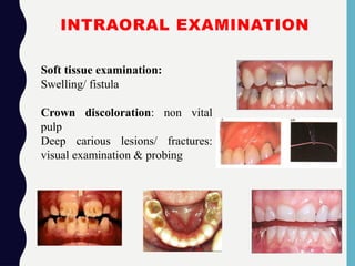 INTRAORAL EXAMINATION
Soft tissue examination:
Swelling/ fistula
Crown discoloration: non vital
pulp
Deep carious lesions/ fractures:
visual examination & probing
 