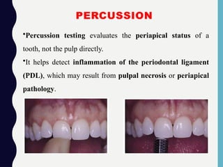 PERCUSSION
•Percussion testing evaluates the periapical status of a
tooth, not the pulp directly.
•It helps detect inflammation of the periodontal ligament
(PDL), which may result from pulpal necrosis or periapical
pathology.
 