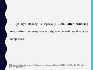 🧠 Tip: Dye staining is especially useful after removing
restorations, as many cracks originate beneath amalgams or
composites.
1.Markose A. Crack tooth syndrome: Diagnosis and management [Internet]. IOSR J Dent Med Sci. 2020 [cited
2025 Jul 4];19(10):4–9.
 