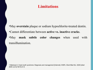 •May overstain plaque or sodium hypochlorite-treated dentin.
•Cannot differentiate between active vs. inactive cracks.
•May mask subtle color changes when used with
transillumination.
Limitations
1.Markose A. Crack tooth syndrome: Diagnosis and management [Internet]. IOSR J Dent Med Sci. 2020 [cited
2025 Jul 4];19(10):4–9.
 