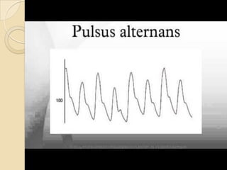 CAUSES OF ABSENT RADIAL
PULSE
 Anatomical abnormality
 Severe atherosclerosis
 Takayasu arteritis (Pulseless disease)
...