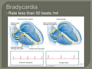 Rate less than 50 beats /mt
 