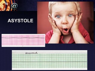 ASYSTOLE
 