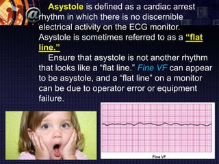 Asystole is defined as a cardiac arrest
rhythm in which there is no discernible
electrical activity on the ECG monitor.
Asystole is sometimes referred to as a “flat
line.”
Ensure that asystole is not another rhythm
that looks like a “flat line.” Fine VF can appear
to be asystole, and a “flat line” on a monitor
can be due to operator error or equipment
failure.
 