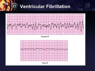 Ventricular Fibrillation
 