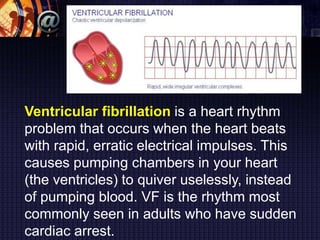 Ventricular fibrillation is a heart rhythm
problem that occurs when the heart beats
with rapid, erratic electrical impulses. This
causes pumping chambers in your heart
(the ventricles) to quiver uselessly, instead
of pumping blood. VF is the rhythm most
commonly seen in adults who have sudden
cardiac arrest.
 