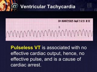 Ventricular Tachycardia
Pulseless VT is associated with no
effective cardiac output, hence, no
effective pulse, and is a cause of
cardiac arrest.
 