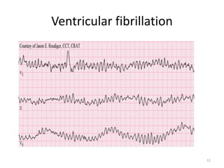 Ventricular fibrillation
12
 