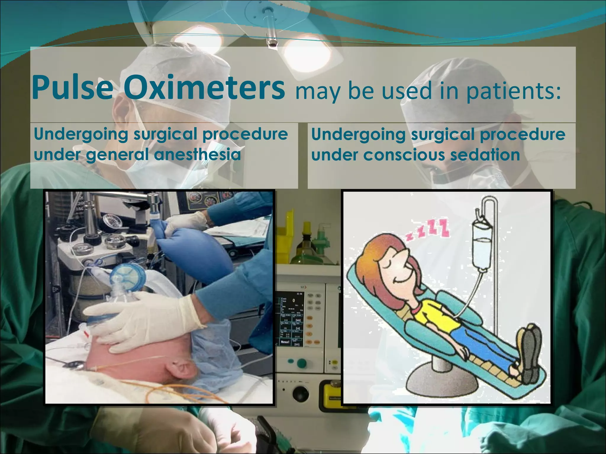 Pulse Oximeters  may be used in patients: Undergoing surgical procedure under general anesthesia  Undergoing surgical procedure under conscious sedation 