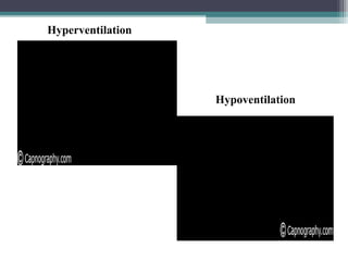 Hyperventilation
Hypoventilation
 