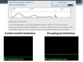Endobronchial intubation Oesophageal intubation
 