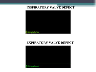 INSPIRATORY VALVE DEFECT
EXPIRATORY VALVE DEFECT
 