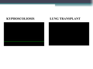 KYPHOSCOLIOSIS LUNG TRANSPLANT
 