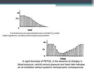 A rapid decrease of PETC02 in the absence of changes in
blood pressure, central venous pressure and heart rate indicates
an air embolism without systemic hemodynamic consequences
 