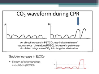 CPR Return of
Spontaneous
Circulation
 