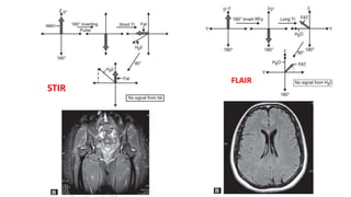FLAIR
STIR
 