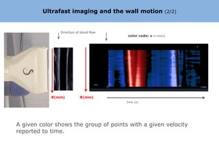 Ultrafast imaging and the wall motion                 (2/2)



                 Direction of blood flow
                                           color code: v in mm/s




          x

              x(mm)          x(mm)
                                           time (s)




A given color shows the group of points with a given velocity
reported to time.
 