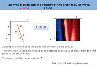 The wall motion and the velocity of the arterial pulse wave
                     V (cm/s)             C (m/s)




                                                                                 t
                              t



       A         .   v            c = Dx /Dt
            Dx
       A’                 v
                     Dt
   x                                           x


2 points of the wall have the same velocity with a time shift Dt
This time shift is the time needed by the arterial pulse wave to travel from the first
point to the second one.

The velocity of the pulse wave is     C
                                                    PWV ~ 5 m/s (ES) and 6 m/s (LS)in the carotid   17
 