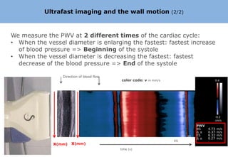 Ultrafast imaging and the wall motion                     (2/2)




We measure the PWV at 2 different times of the cardiac cycle:
• When the vessel diameter is enlarging the fastest: fastest increase
  of blood pressure => Beginning of the systole
• When the vessel diameter is decreasing the fastest: fastest
  decrease of the blood pressure => End of the systole

                   Direction of blood flow
                                             color code: v in mm/s




            x

                                                                      ES
                x(mm) x(mm)
                                             time (s)
 
