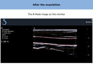 After the acquisition


The B-Mode image on the monitor
 