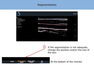 Segmentation




    4   If the segmentation is not adequate,
        change the position and/or the size of
        the box.



          At the bottom of the monitor
 