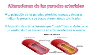La palpación de las paredes arteriales rugosas y sinuosas
indican la presencia de placas ateromatosas calcificadas
Palpación de arteria flexuosa que “rueda” bajo el dedo como
un cordón duro se encuentra en arterioesclerosis avanzada
 